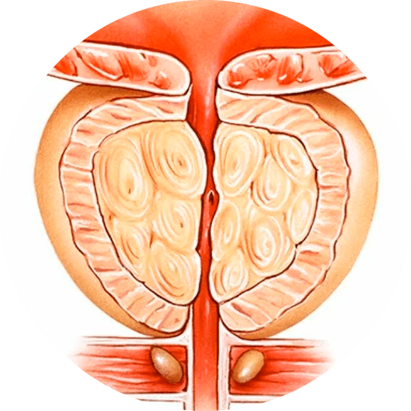 Neārstēta prostatīta sekas