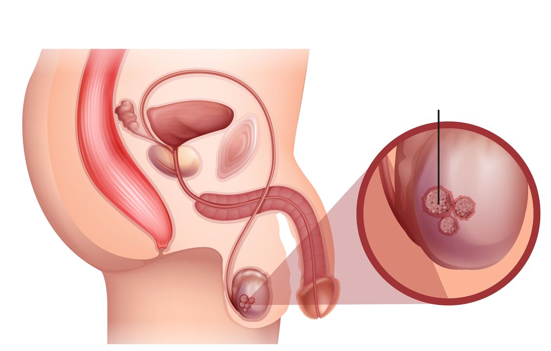 prostatas vēža pazīmes