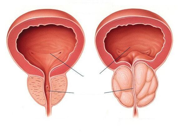 vesela un slima prostata