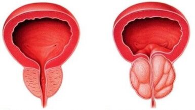 vesela un iekaisusi prostata ar prostatītu